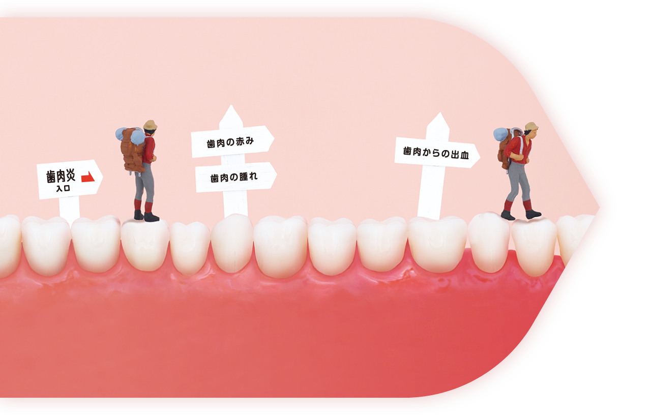 歯周炎、歯肉の赤み、歯肉の腫れ、歯肉からの出血