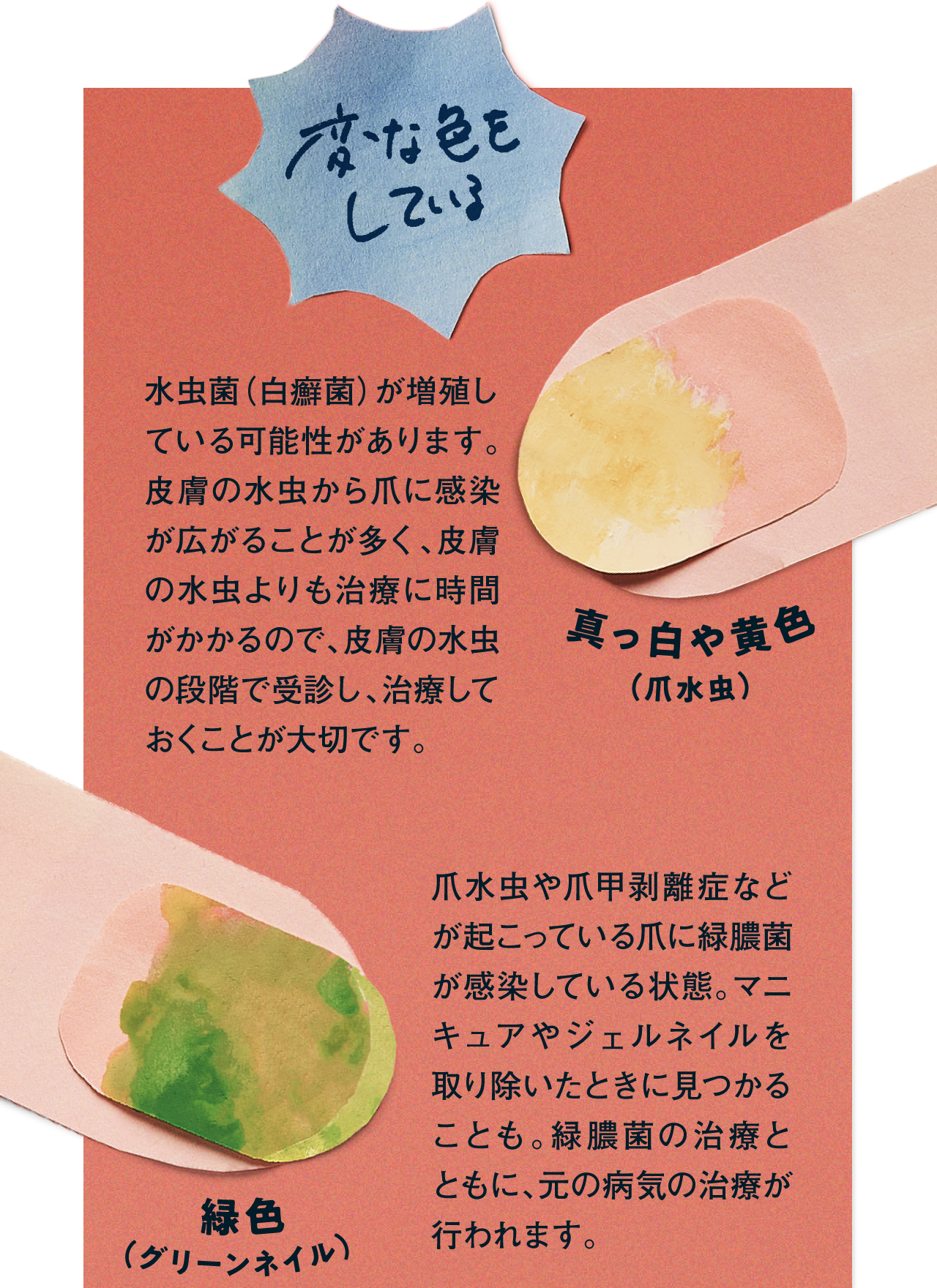 爪水虫　グリーンネイル